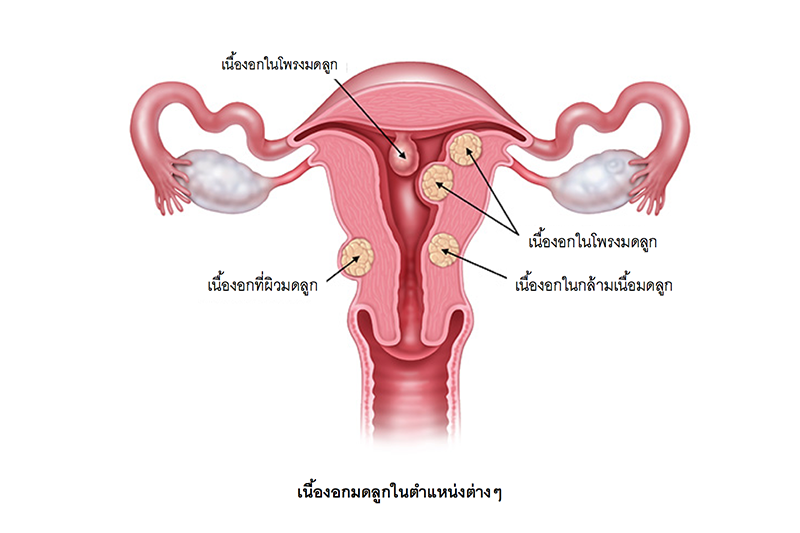 Endometrial-polyp-insert