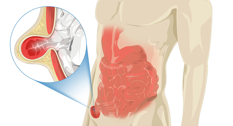 hernia, ក្លនលូនពងស្វាស