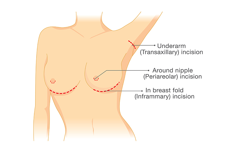 乳房増大手術、シリコンの配置